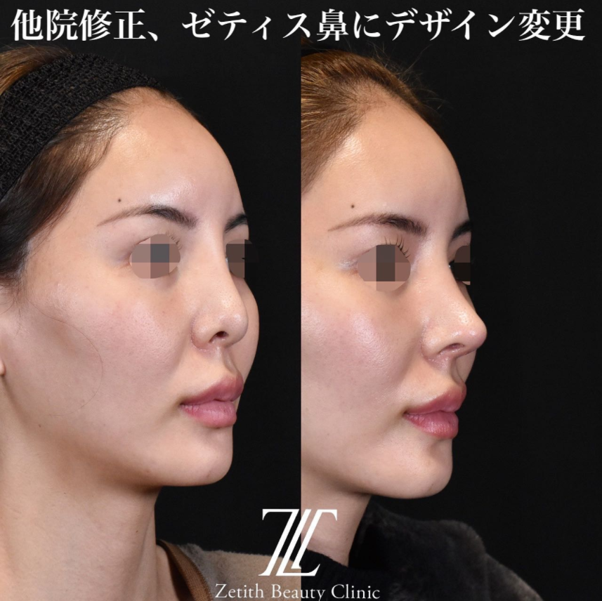鉄医師による鼻のフルコースの施術前／施術後1ヶ月