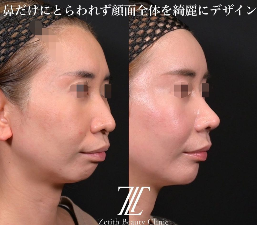鉄医師による鼻のフルコースの施術前／施術後3ヶ月