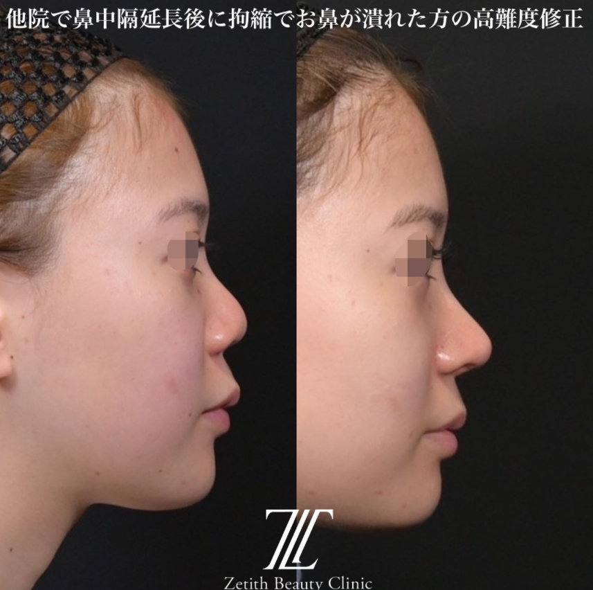 鉄医師による鼻のフルコースの施術前／施術後1ヶ月 หลัง 