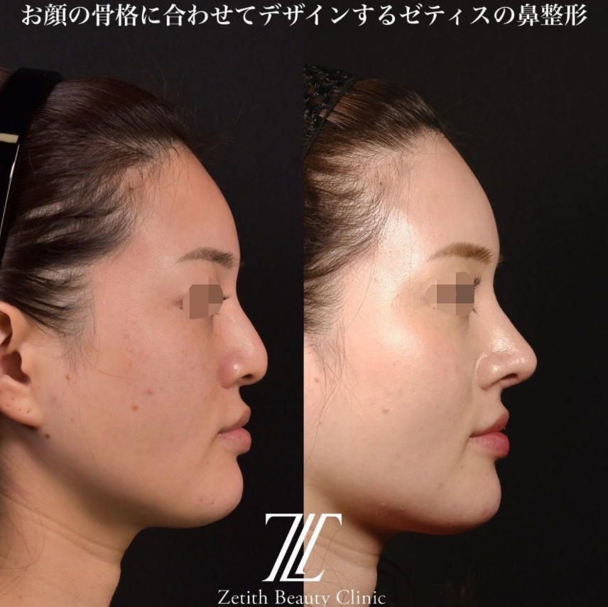 鉄医師による鼻のフルコースの施術前／施術後3ヶ月