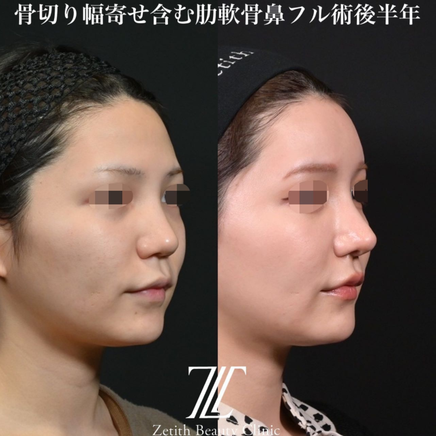 鉄医師による鼻のフルコースの施術前／施術後6ヶ月 施術後 