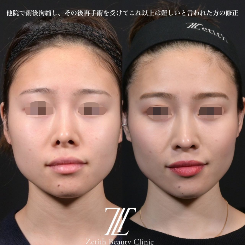 鉄医師による鼻のフルコースの施術前／施術後1ヶ月