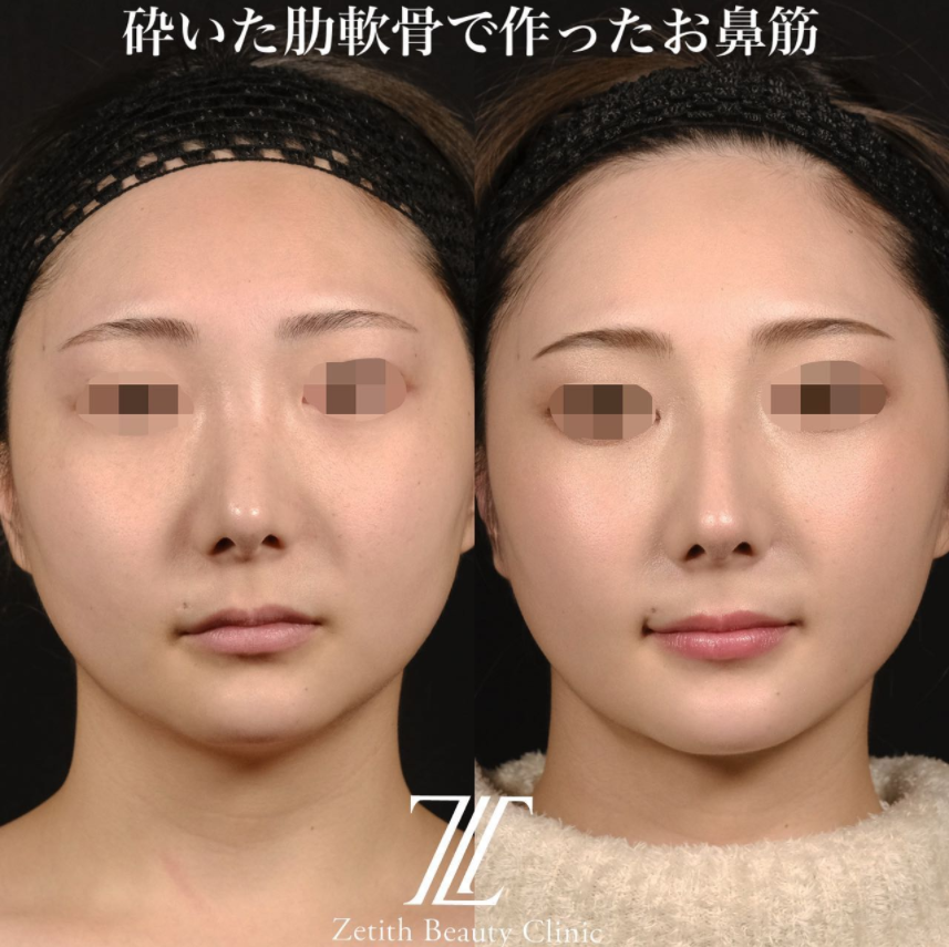 鉄医師による鼻のフルコースの施術前／施術後1ヶ月