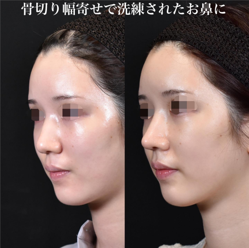 鉄医師による鼻のフルコースの施術前／施術後1ヶ月