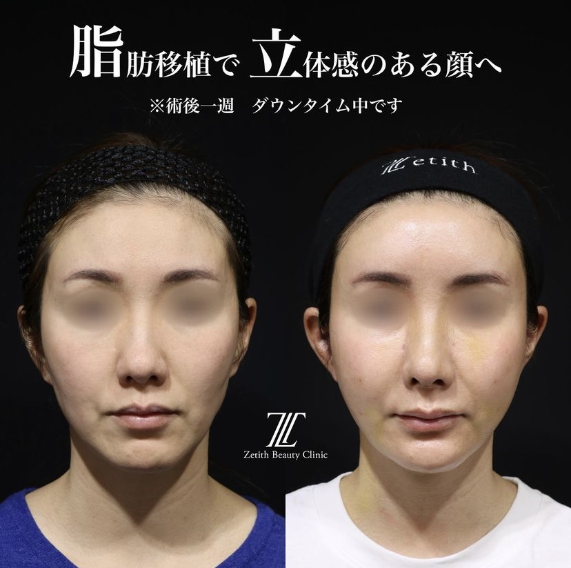 《術後1週間》王医師による糸リフト＋全顔脂肪注入