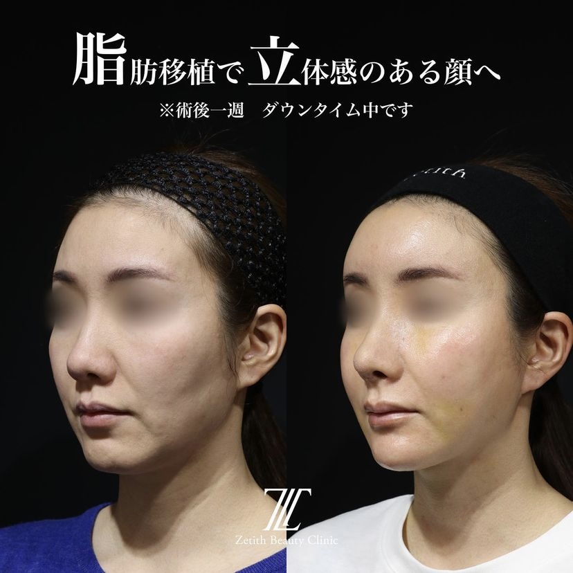《術後1週間》王医師による糸リフト＋全顔脂肪注入 施術後 