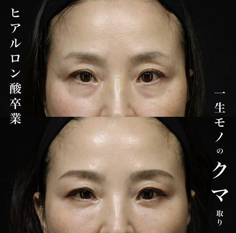 《術後1ヶ月》王医師によるクマ取り＋脂肪注入