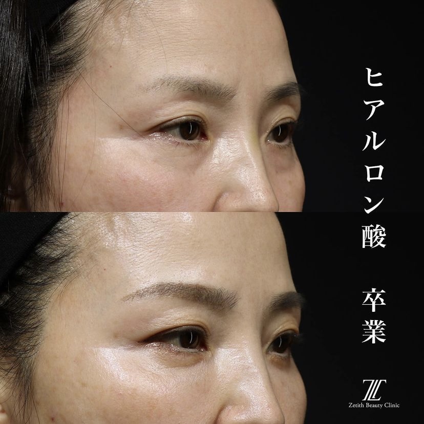 《術後1ヶ月》王医師によるクマ取り＋脂肪注入 施術後 