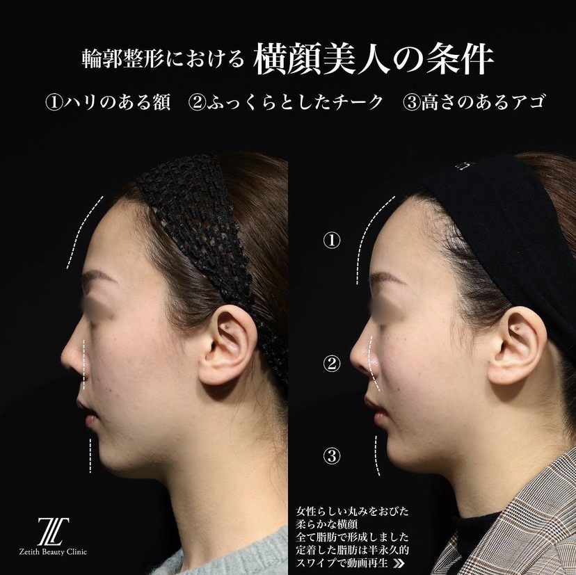 《術後1ヶ月》王医師による糸リフト＋全顔脂肪注入 After 