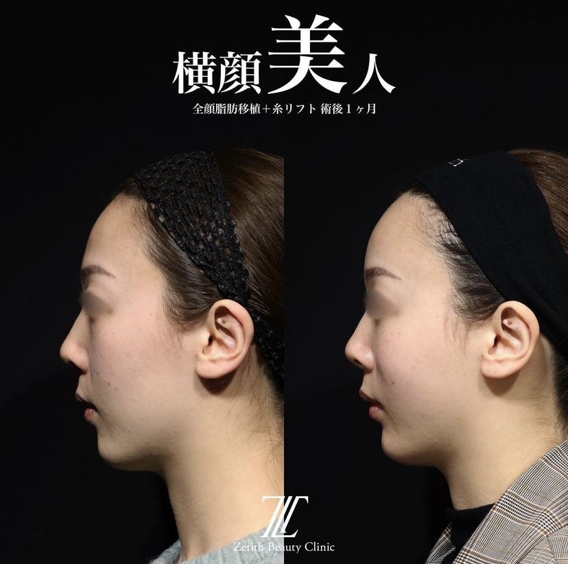 《術後1ヶ月》王医師による糸リフト＋全顔脂肪注入