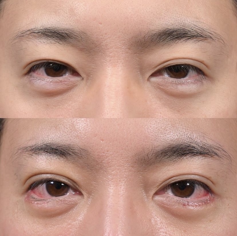 《術後1週間》上木原医師による二重埋没法＋タレ目形成＋目尻切開