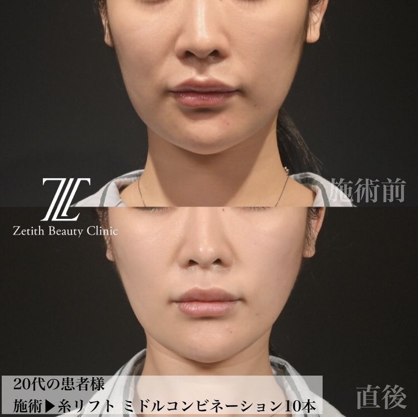 《術直後》新井医師による糸リフト