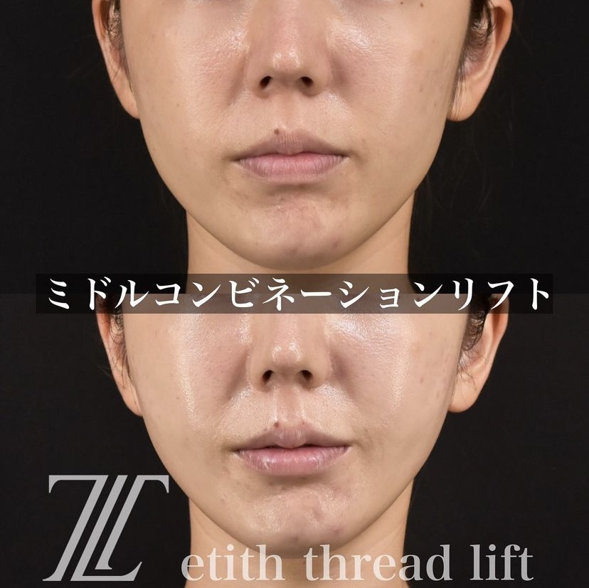 《術直後》新井医師による糸リフト