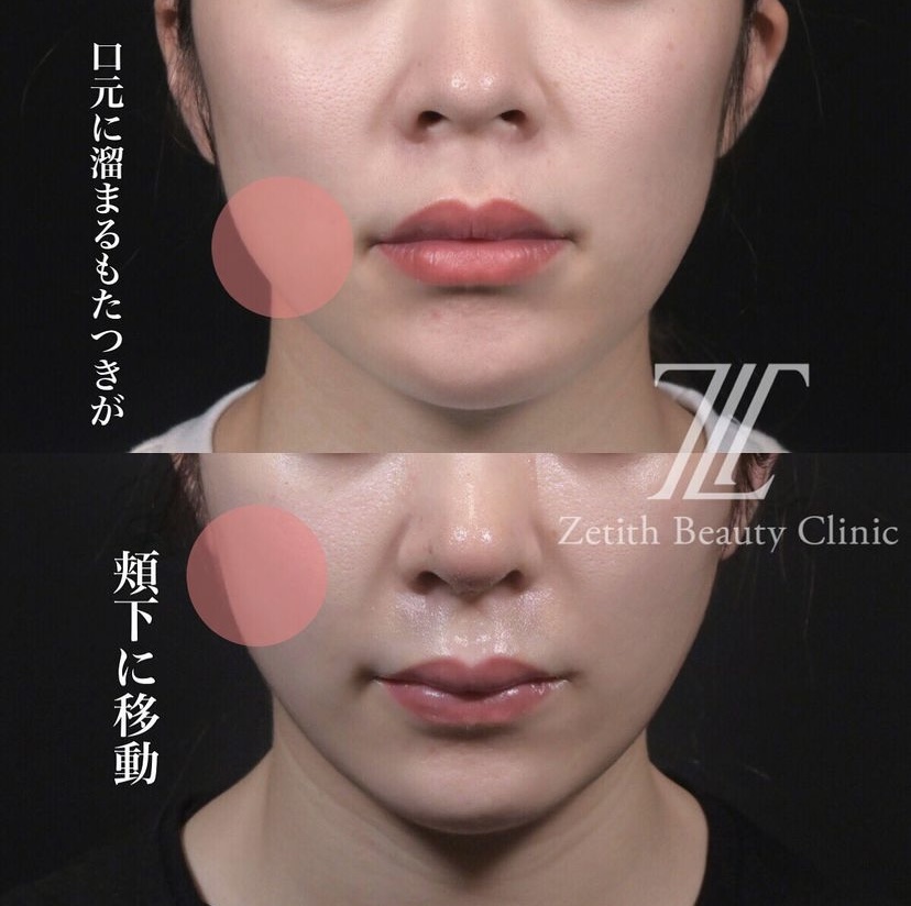 《術後1週間》新井医師による糸リフト Sau 