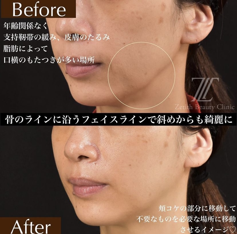 《術後1ヶ月》新井医師による糸リフト 施術後 