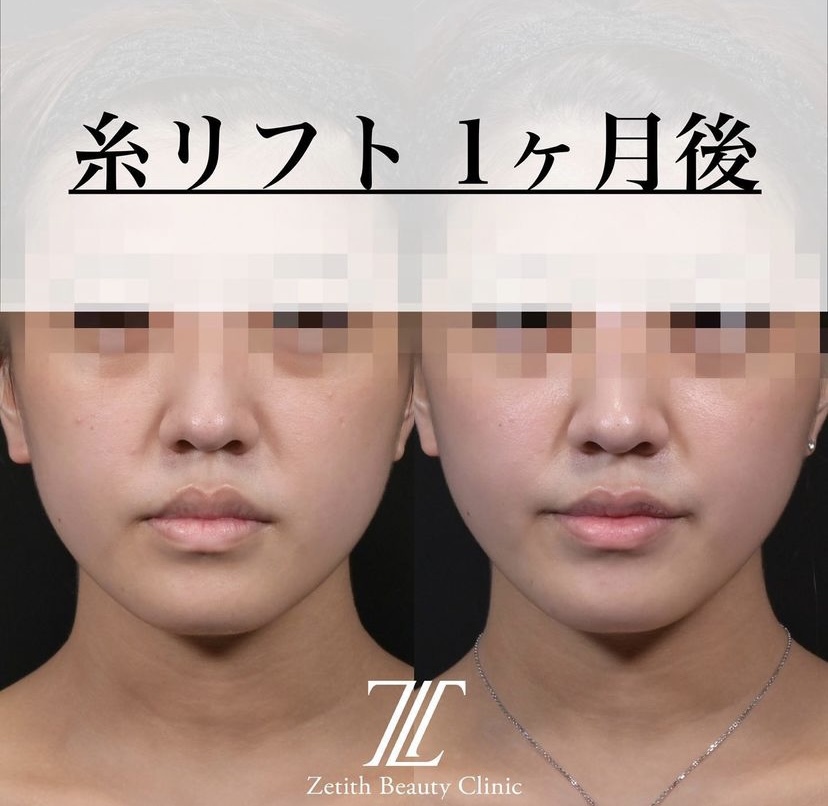 《術後1ヶ月》新井医師による糸リフト