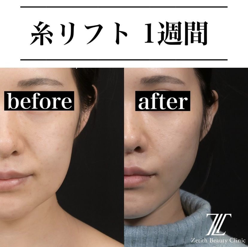 《術後1週間》新井医師による糸リフト