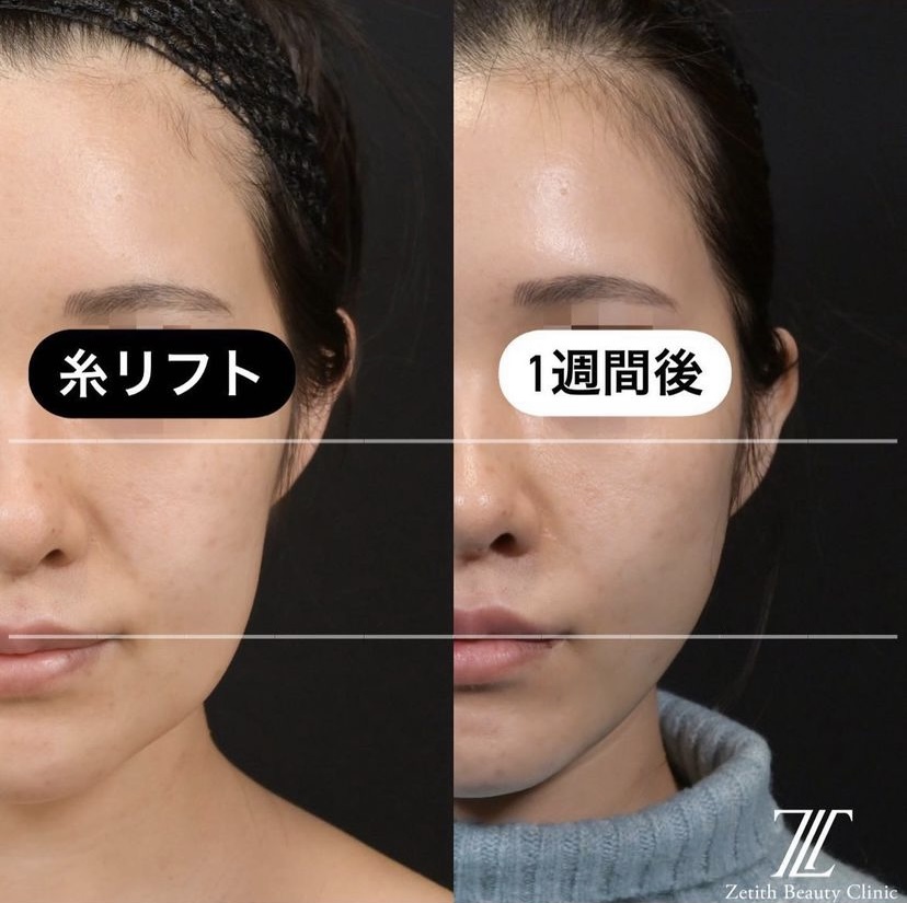 《術後1週間》新井医師による糸リフト Sau 