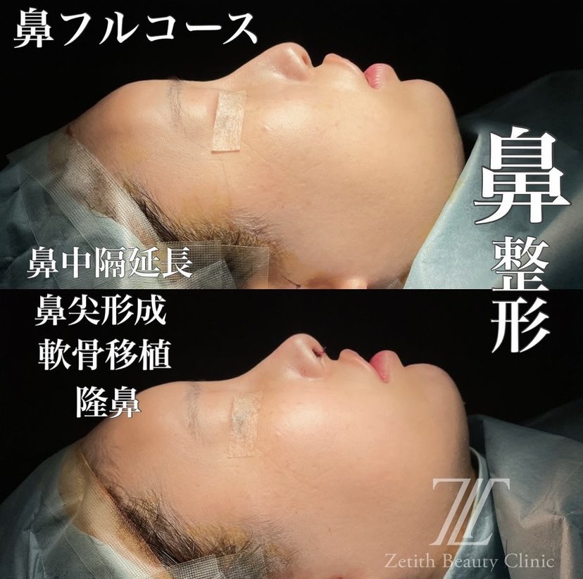 《術直後》守屋医師による鼻整形 Дараа 