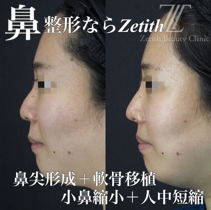 《術後1ヶ月》守屋医師による鼻整形 Дараа 