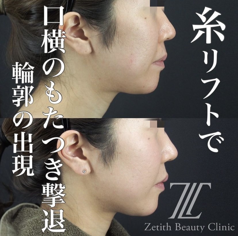 《術後1週間》守屋医師による糸リフト หลัง 
