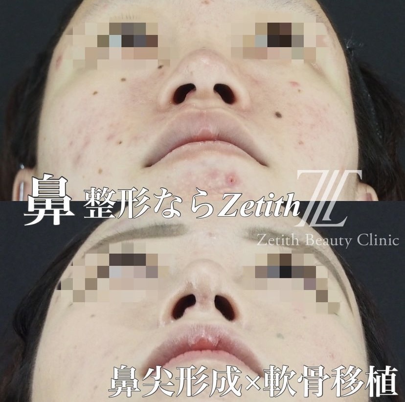 《術後1ヶ月》守屋医師による鼻整形 施術後 