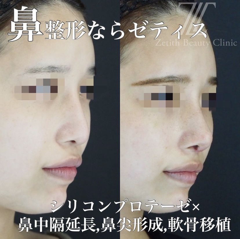 《術後1週間》守屋医師による鼻整形 Sau 