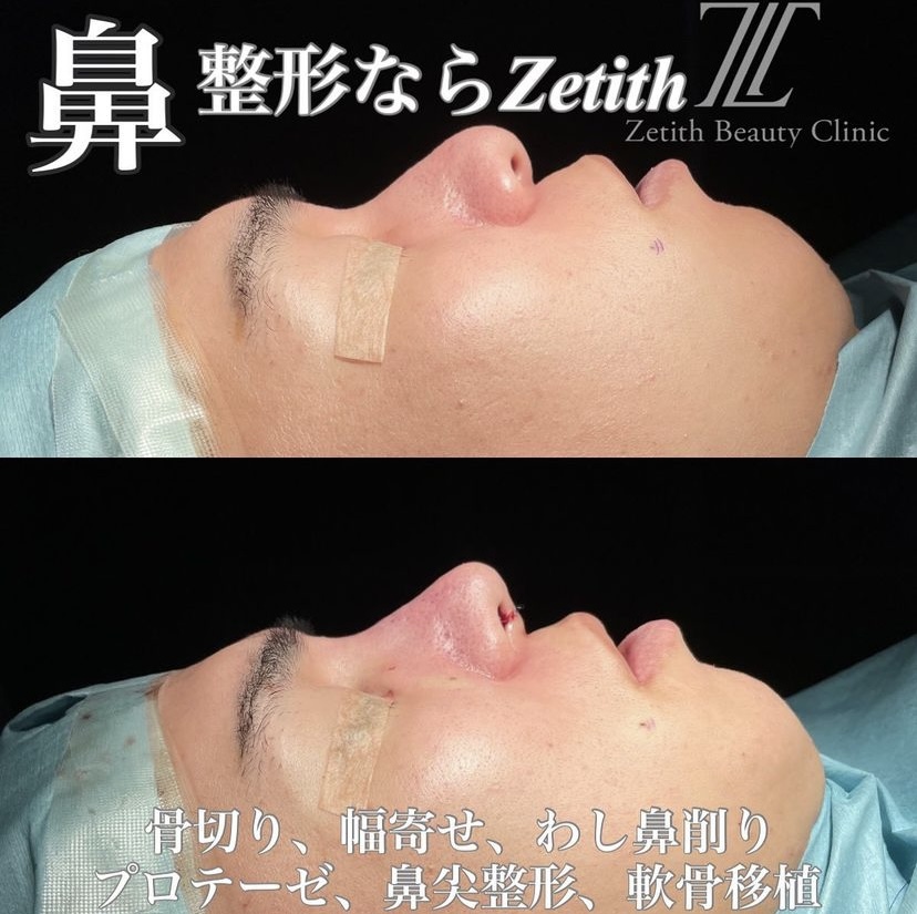 《術直後》守屋医師による鼻整形 术后 