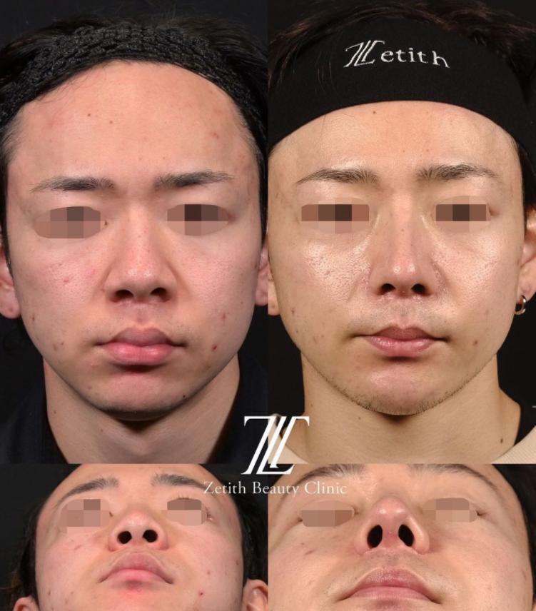 鉄医師による鼻のフルコースの施術前／施術後1ヶ月 施術後 