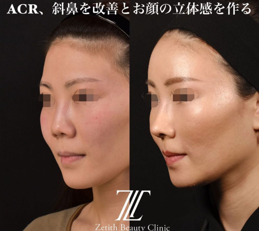 鉄医師による鼻のフルコースの施術前／施術後6ヶ月