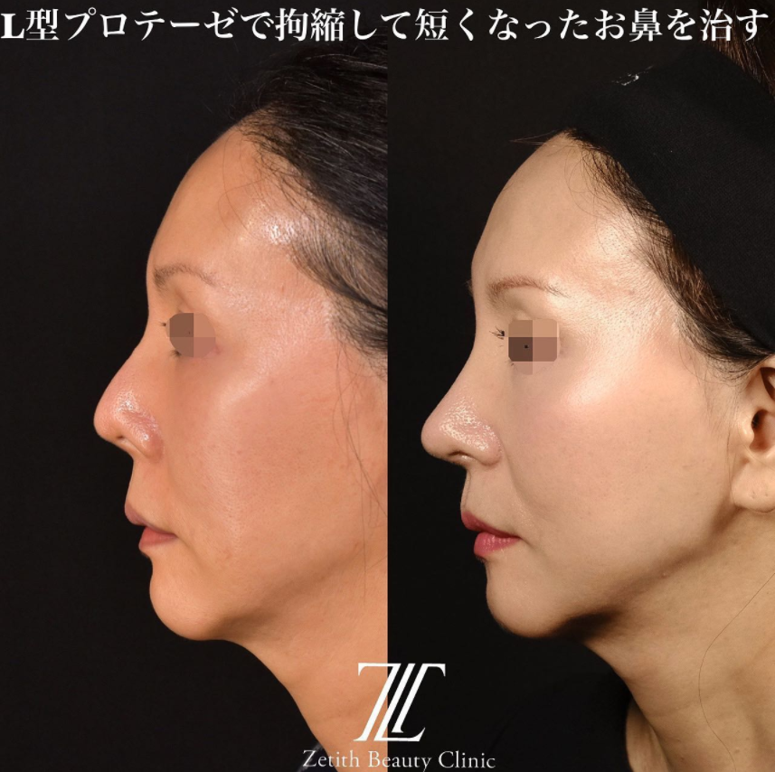 鉄医師による鼻のフルコースの施術前／施術後4ヶ月