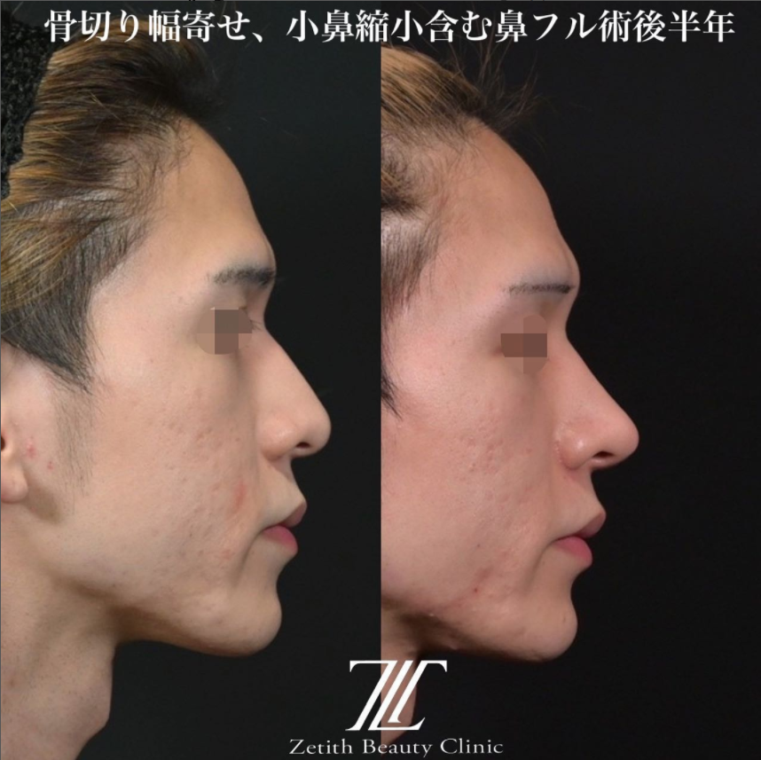 鉄医師による鼻のフルコースの施術前／施術後6ヶ月 หลัง 