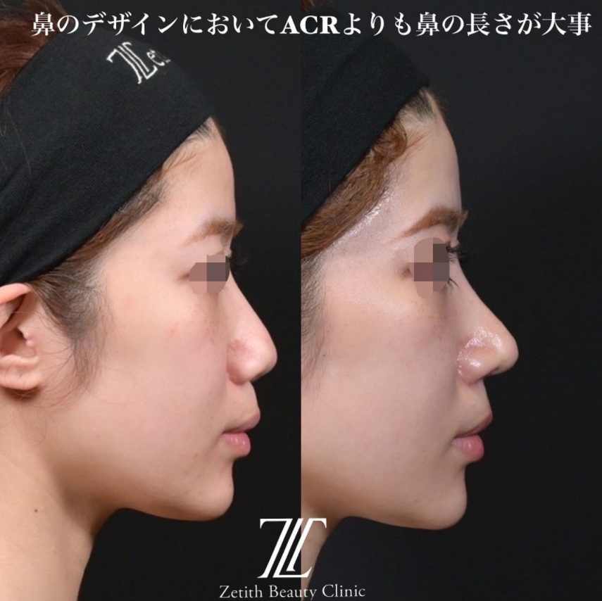 鉄医師による鼻のフルコースの施術前／施術後1ヶ月