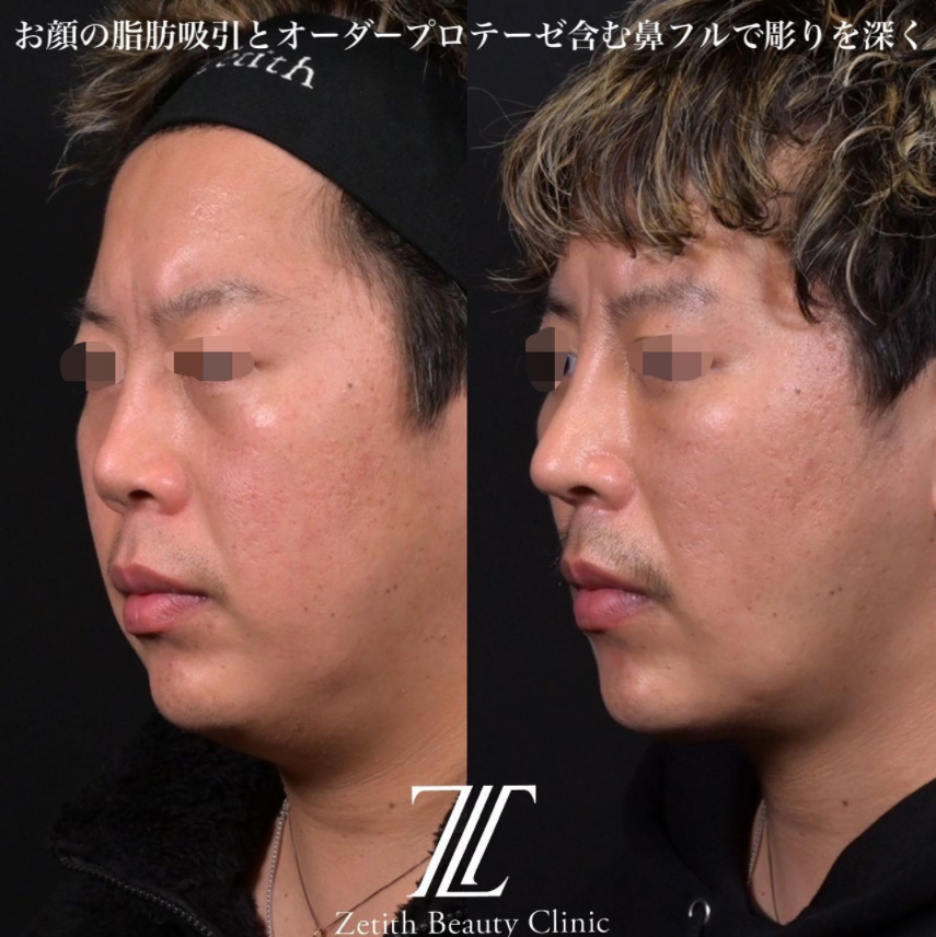 鉄医師による鼻のフルコースの施術前／施術後1ヶ月
