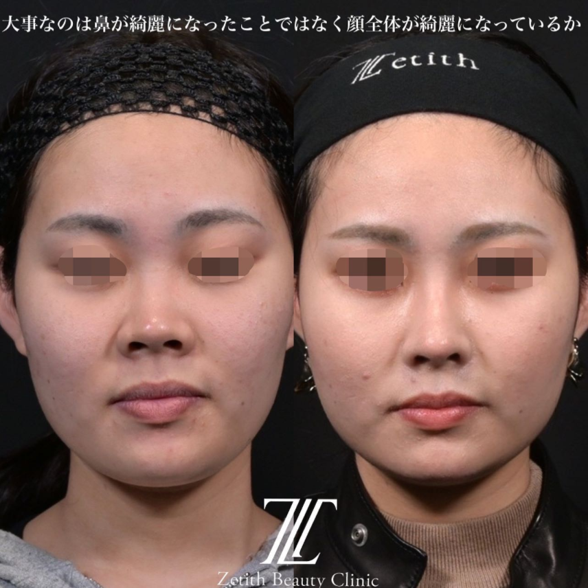 鉄医師による鼻のフルコースの施術前／施術後3ヶ月