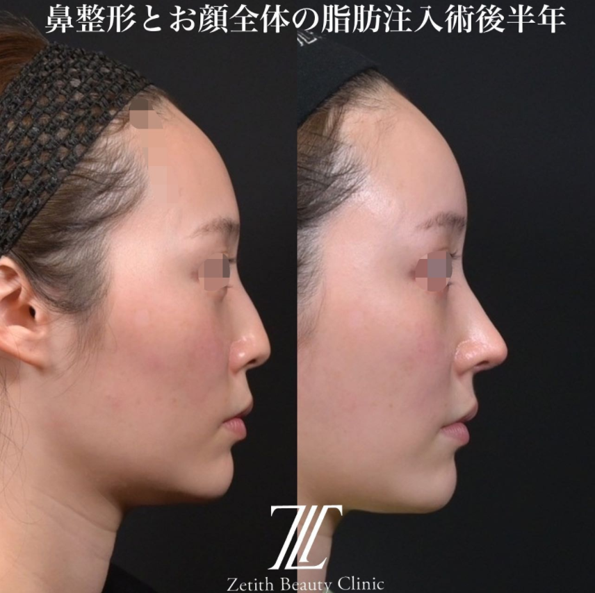 鉄医師による鼻のフルコースの施術前／施術後6ヶ月 หลัง 