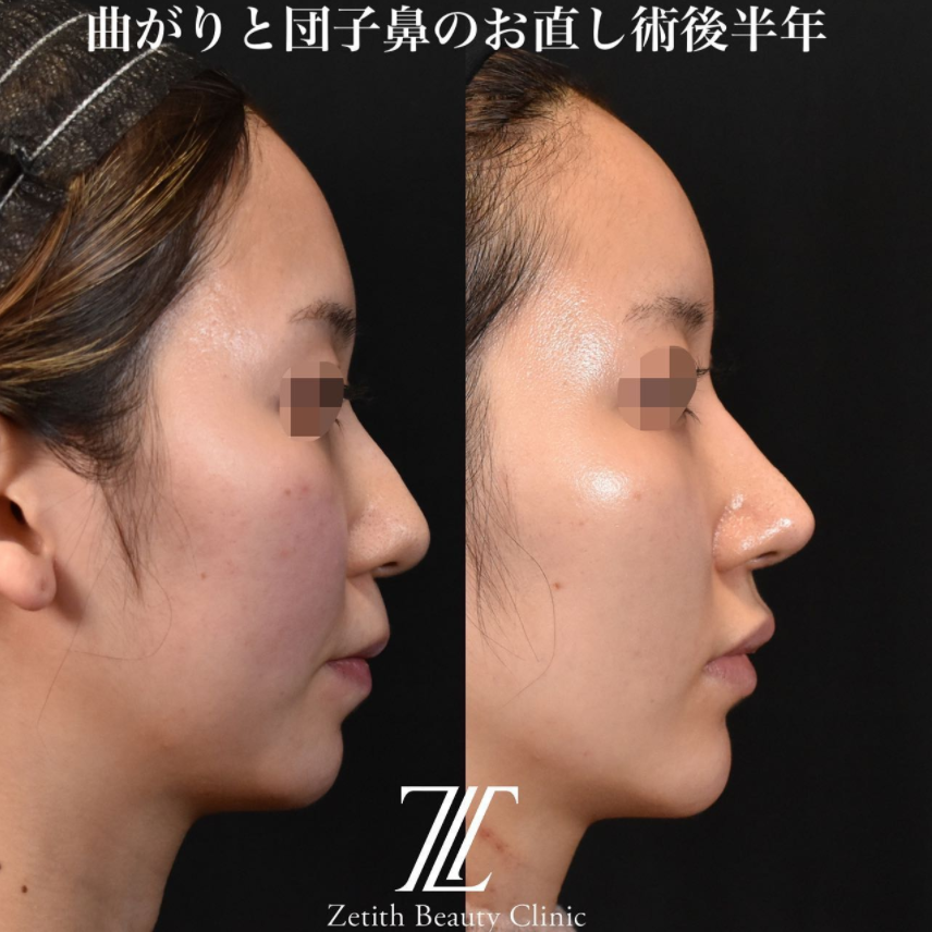 鉄医師による鼻のフルコースの施術前／施術後6ヶ月 施術後 