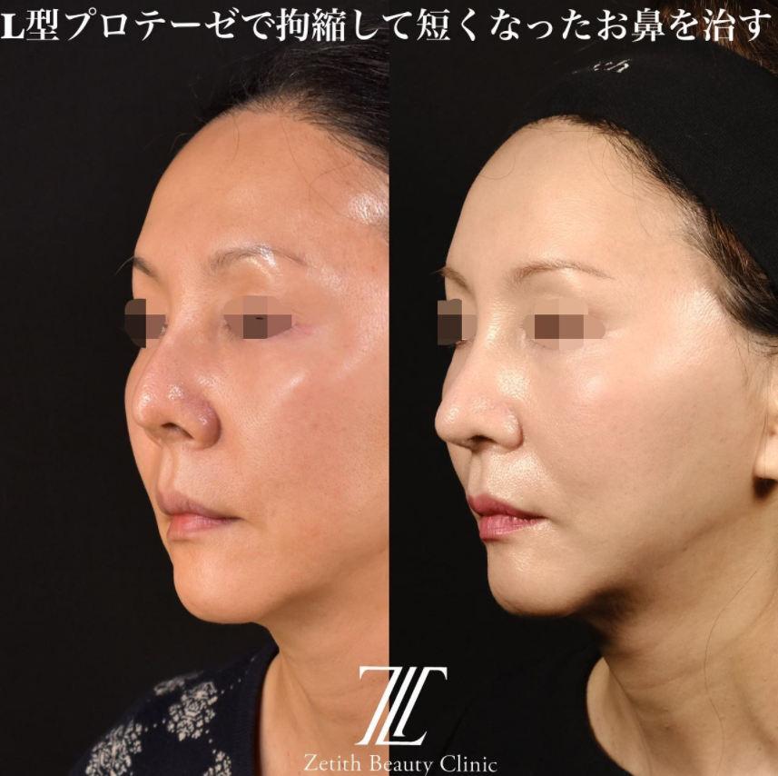 鉄医師による鼻のフルコースの施術前／施術後4ヶ月 Sonra 