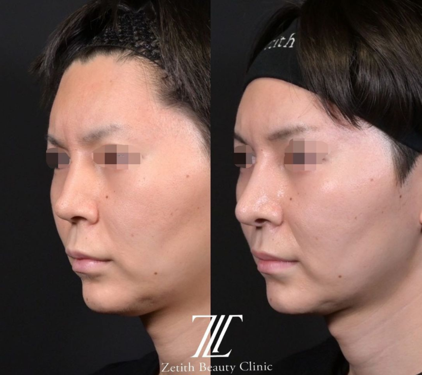 鉄医師による鼻のフルコースの施術前／施術後3ヶ月