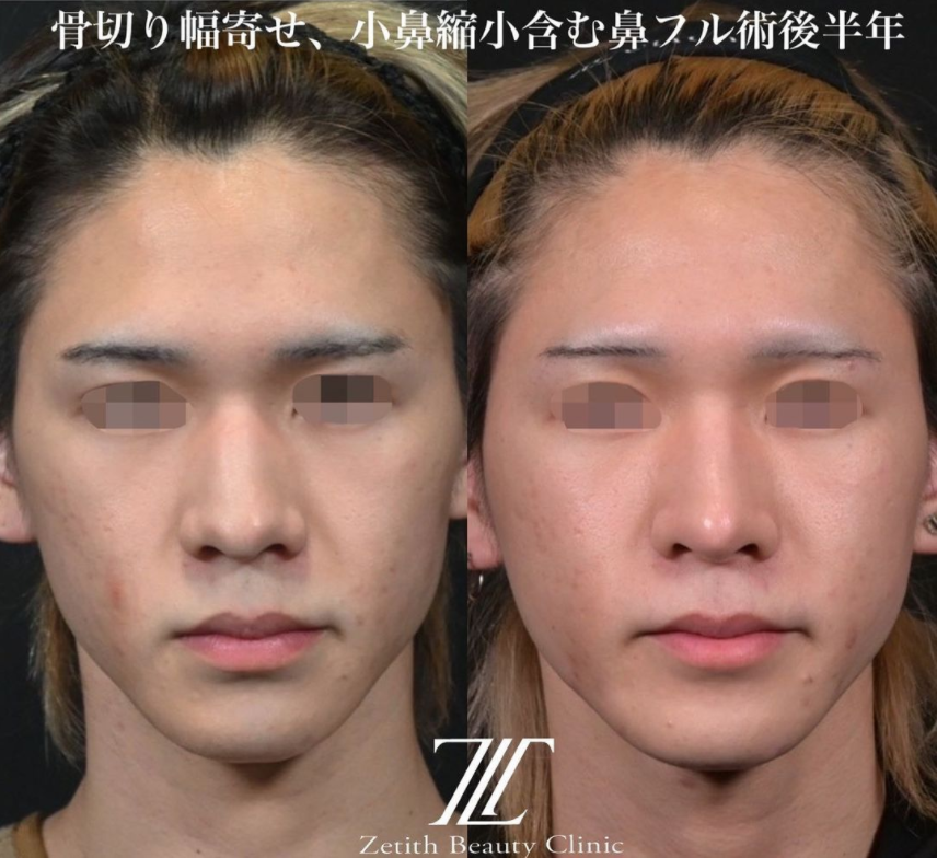 鉄医師による鼻のフルコースの施術前／施術後6ヶ月