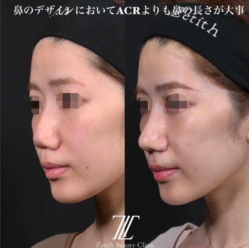 鉄医師による鼻のフルコースの施術前／施術後1ヶ月 施術後 