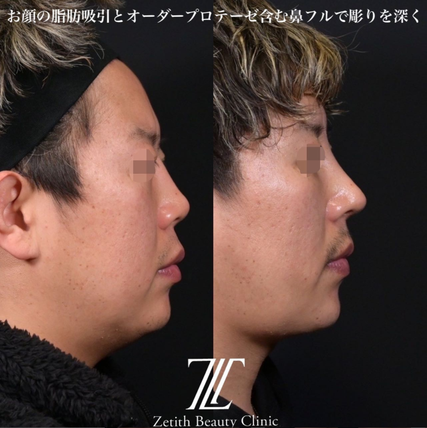 鉄医師による鼻のフルコースの施術前／施術後1ヶ月 Дараа 