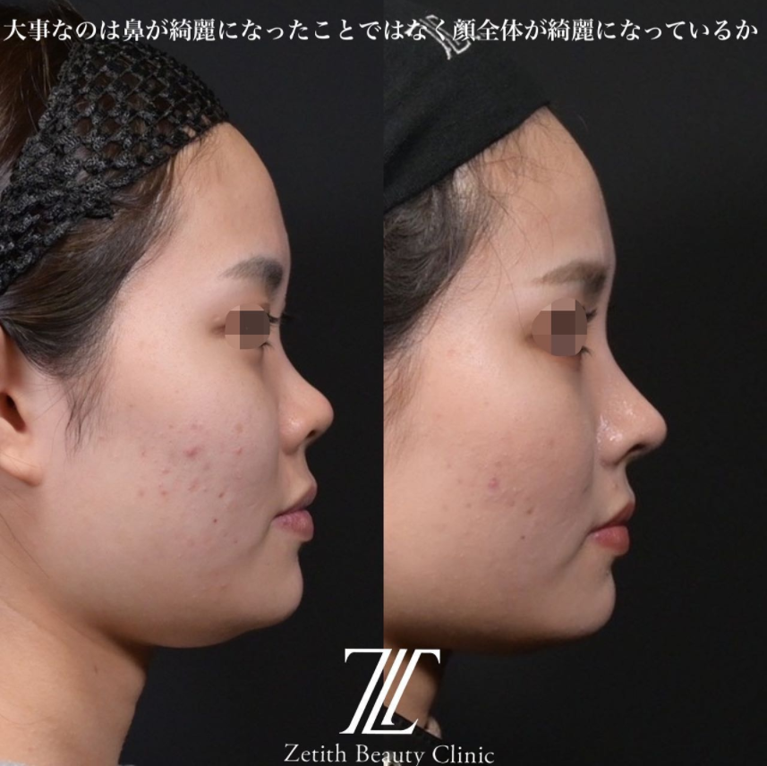鉄医師による鼻のフルコースの施術前／施術後3ヶ月 施術後 