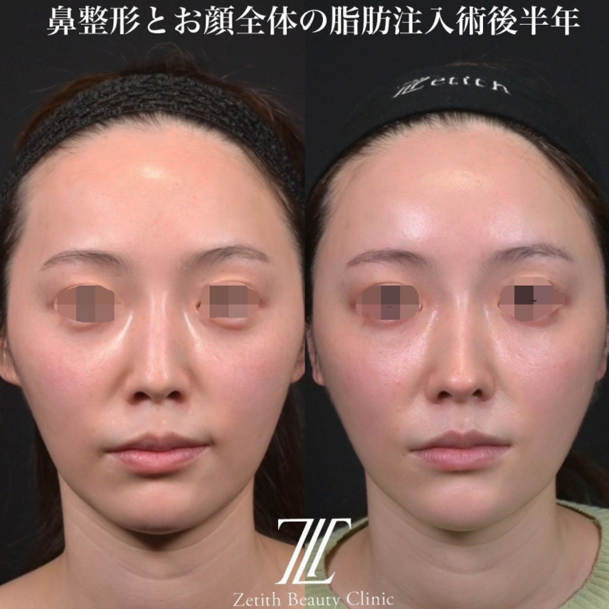 鉄医師による鼻のフルコースの施術前／施術後6ヶ月