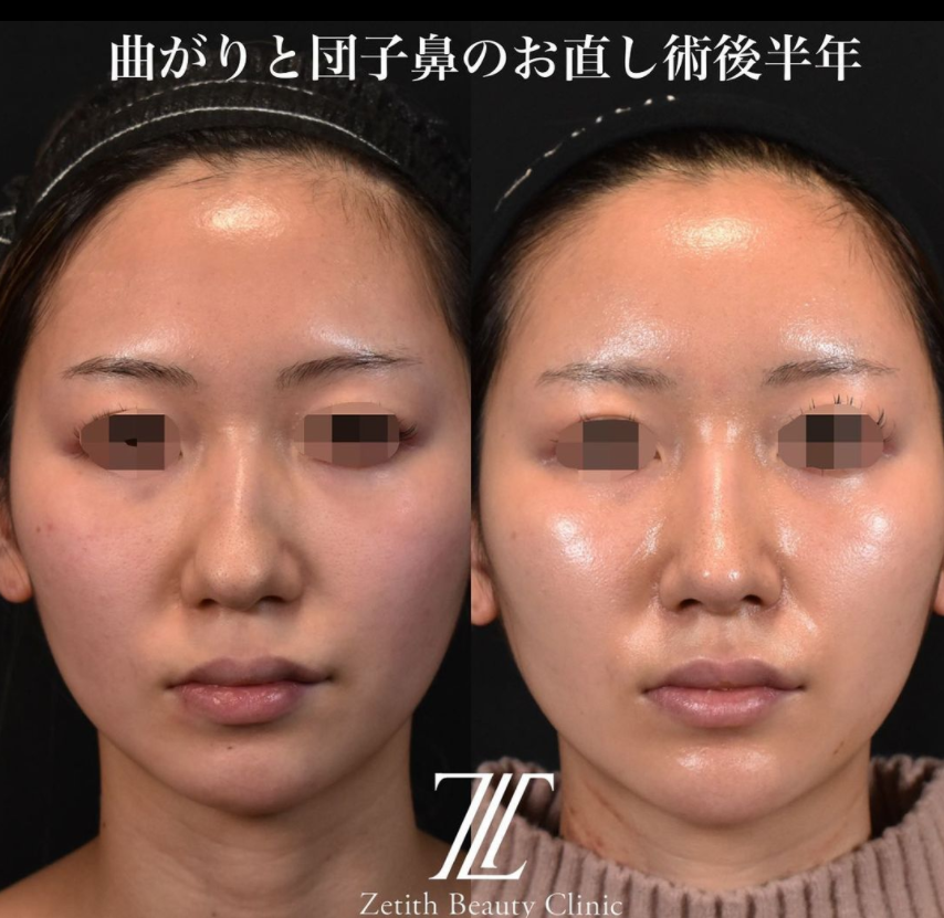 鉄医師による鼻のフルコースの施術前／施術後6ヶ月