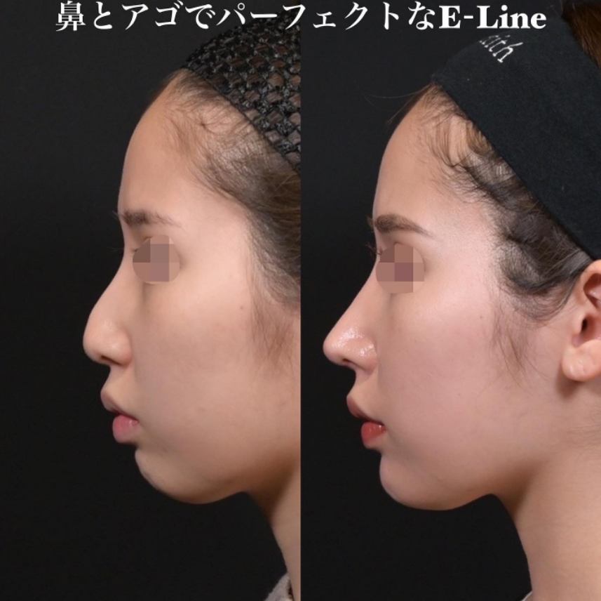 鉄医師による鼻のフルコースの施術前／施術後4ヶ月