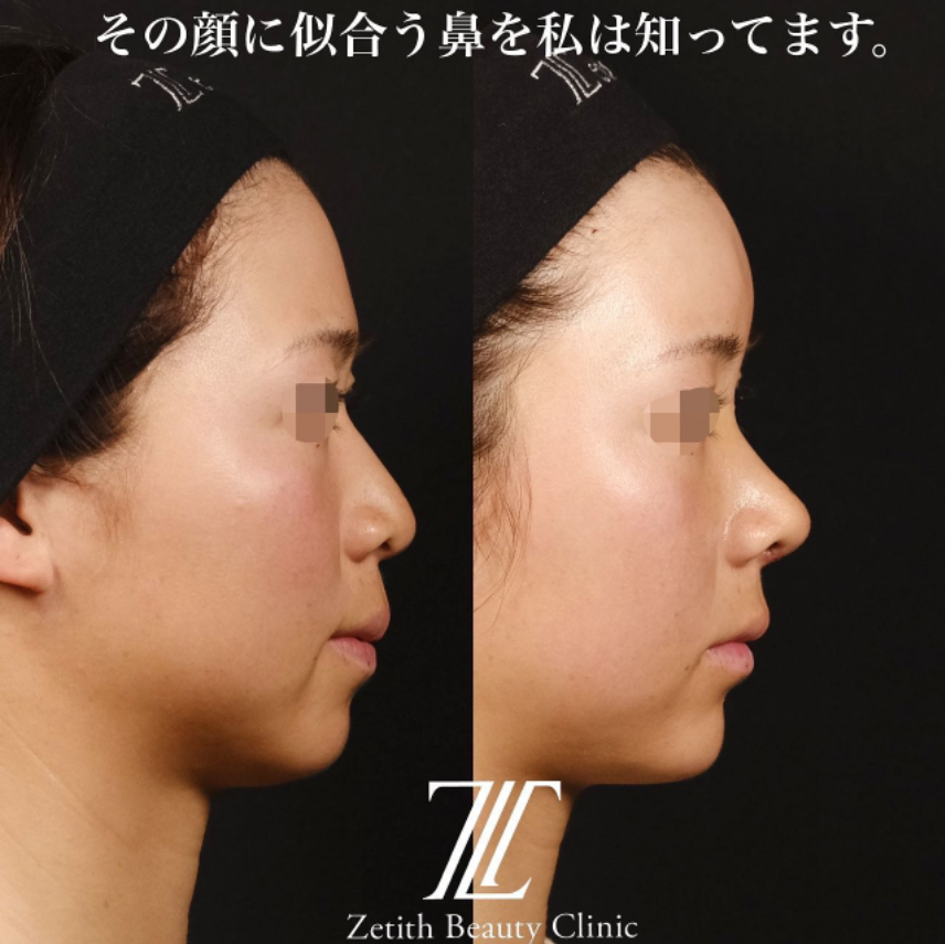鉄医師による鼻のフルコースの施術前／施術後1ヶ月