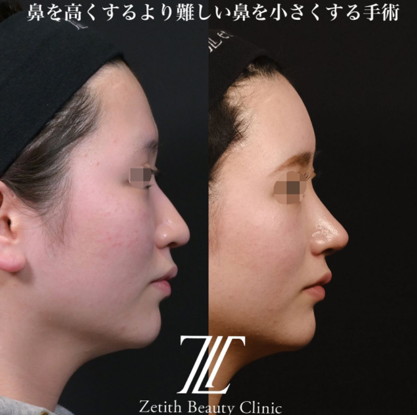鉄医師による鼻のフルコースの施術前／施術後1ヶ月