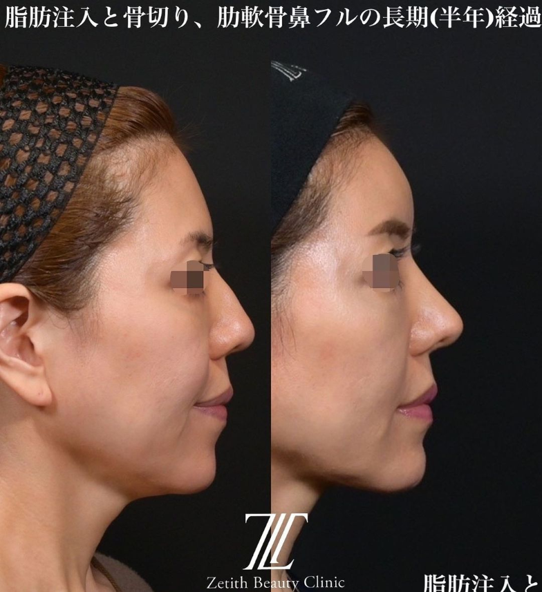 鉄医師による鼻のフルコースの施術前／施術後6ヶ月 施術後 