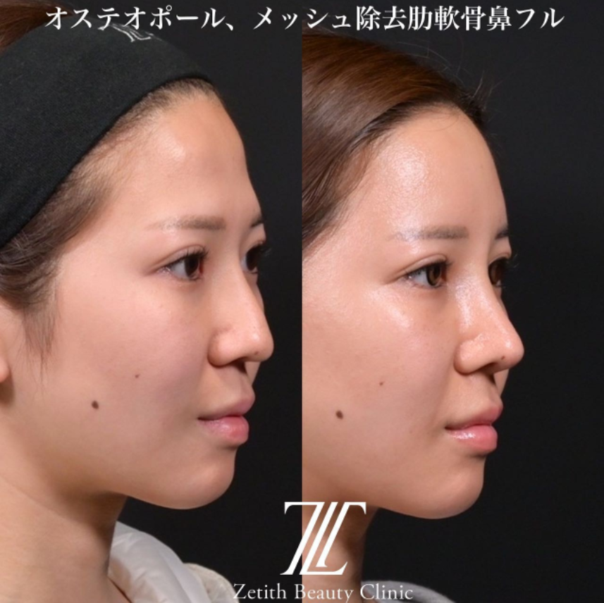 鉄医師による鼻のフルコースの施術前／施術後1ヶ月
